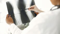 5 Kiat Mencegah Osteoporosis demi Tulang Kuat